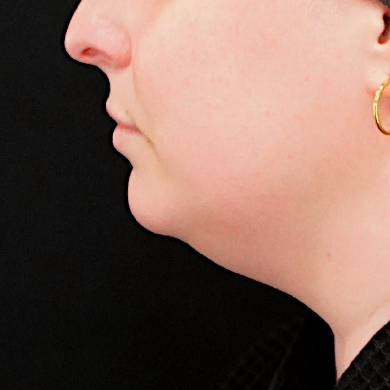 Platysmaplasty Before & After Gallery - Patient 204180 - Image 3