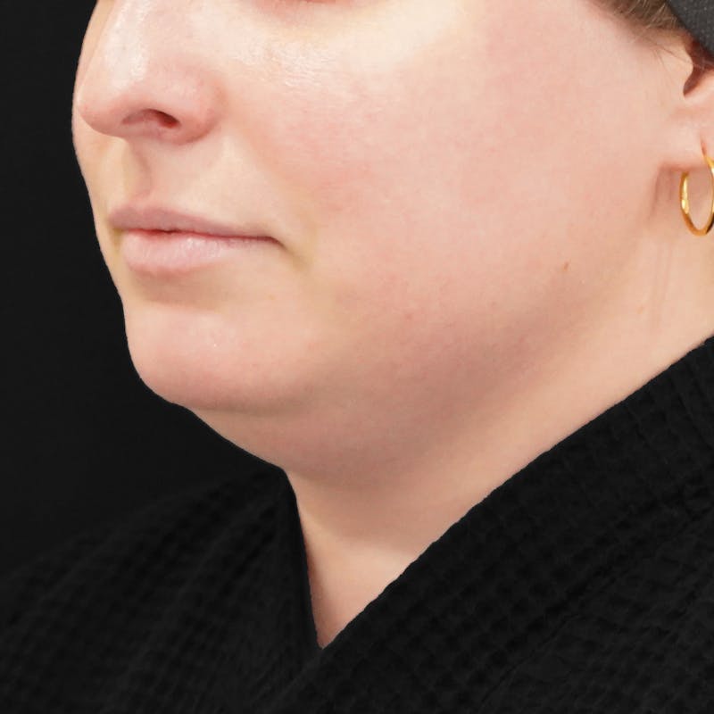 Platysmaplasty Before & After Gallery - Patient 204180 - Image 1