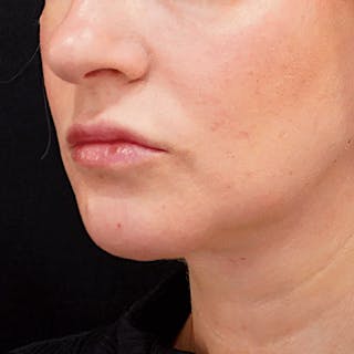 Platysmaplasty Before & After Gallery - Patient 346835 - Image 2