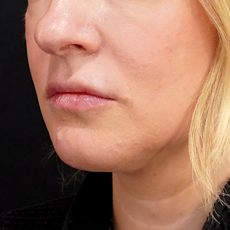 Platysmaplasty Before & After Gallery - Patient 346835 - Image 1
