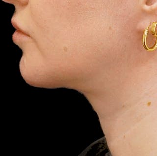 Platysmaplasty Before & After Gallery - Patient 346835 - Image 4