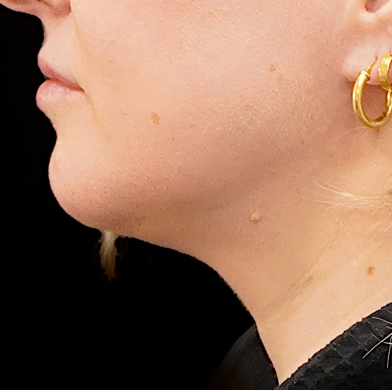 Platysmaplasty Before & After Gallery - Patient 346835 - Image 3