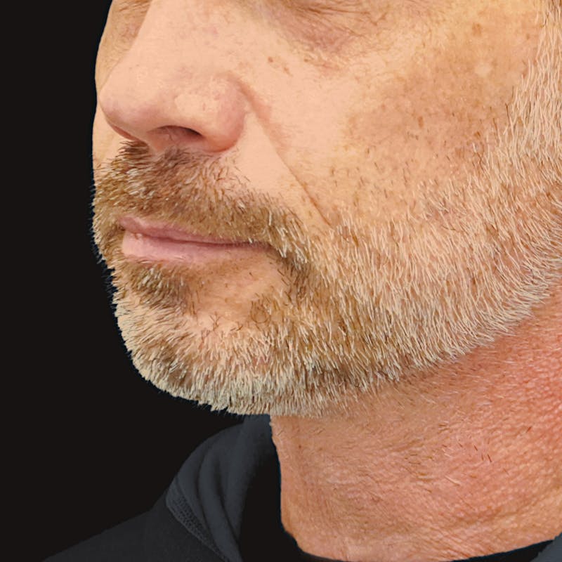 Platysmaplasty Before & After Gallery - Patient 352686 - Image 2