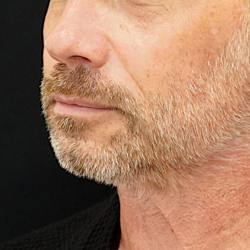 Platysmaplasty Before & After Gallery - Patient 352686 - Image 1