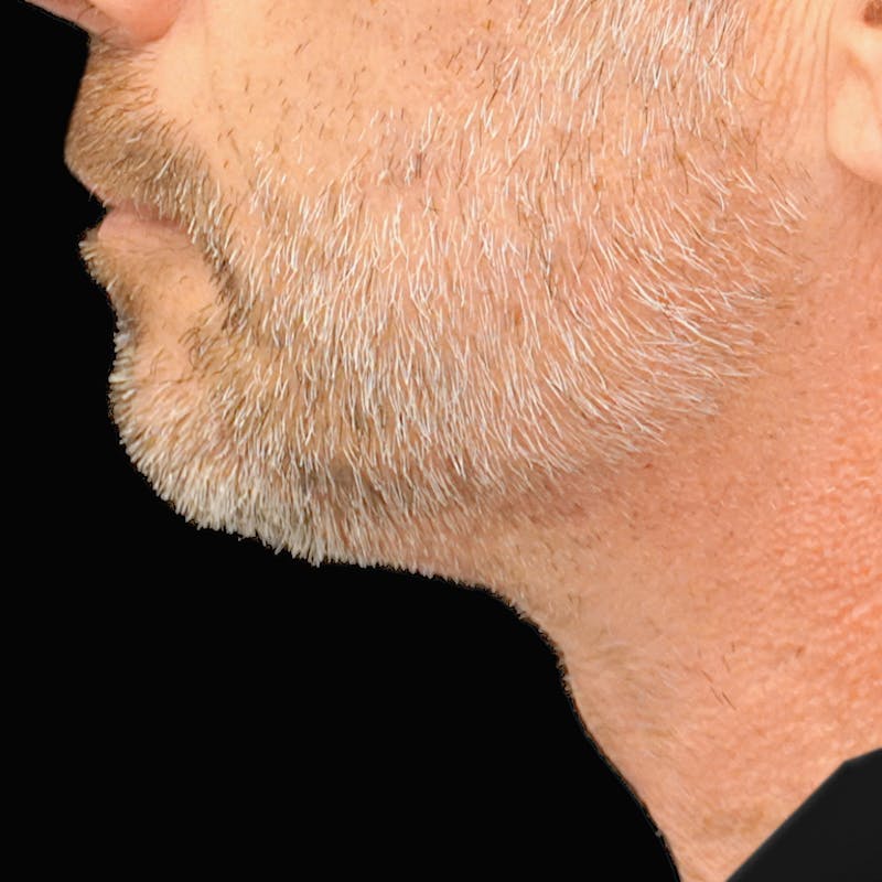 Platysmaplasty Before & After Gallery - Patient 352686 - Image 4