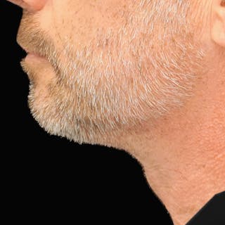 Platysmaplasty Before & After Gallery - Patient 352686 - Image 4