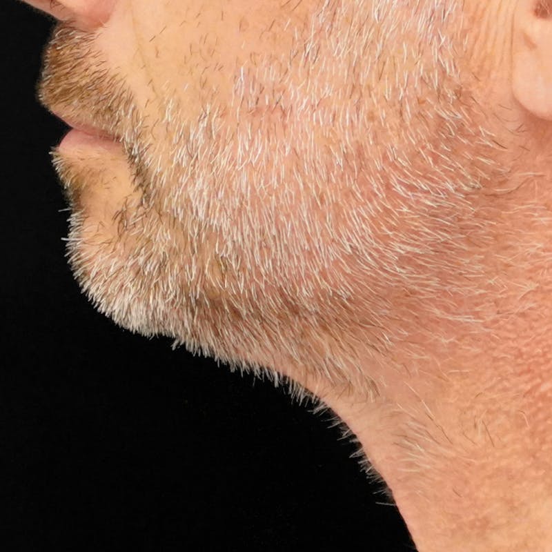 Platysmaplasty Before & After Gallery - Patient 352686 - Image 3