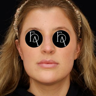 Submental Liposuction Before & After Gallery - Patient 114660 - Image 6
