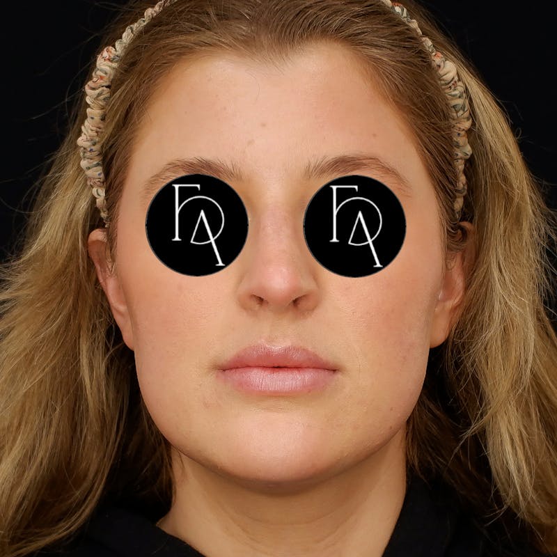 Submental Liposuction Before & After Gallery - Patient 114660 - Image 6