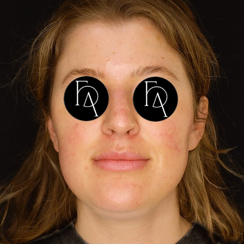 Submental Liposuction Before & After Gallery - Patient 114660 - Image 5