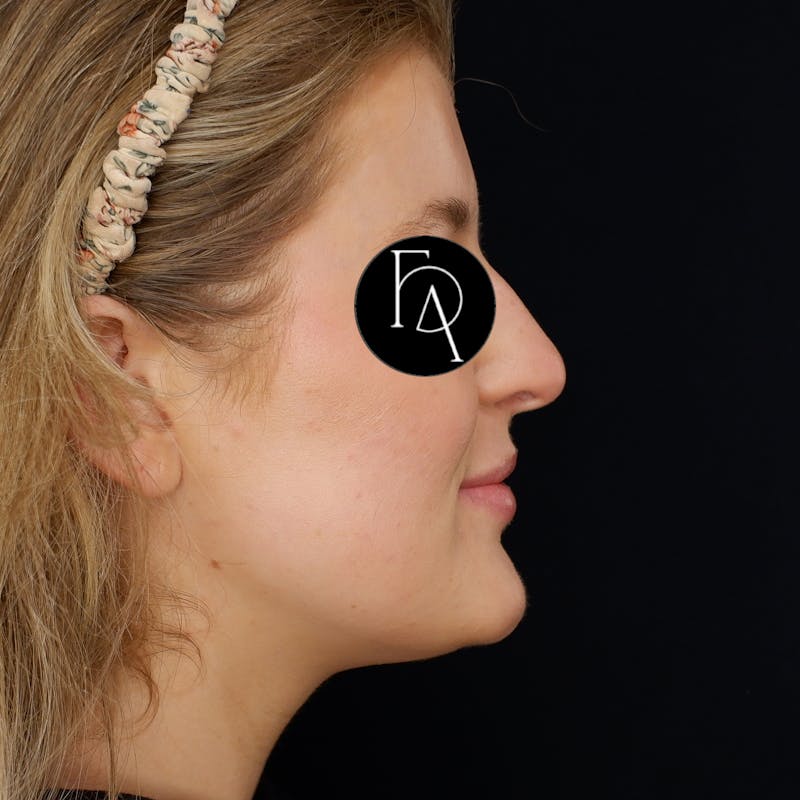 Submental Liposuction Before & After Gallery - Patient 114660 - Image 2