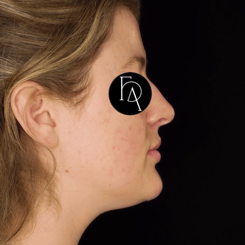 Submental Liposuction Before & After Gallery - Patient 114660 - Image 1