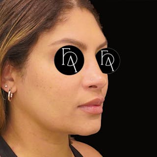 Submental Liposuction Before & After Gallery - Patient 162446 - Image 4