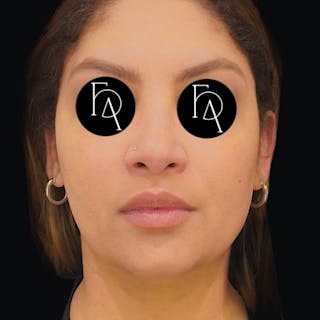 Submental Liposuction Before & After Gallery - Patient 162446 - Image 6