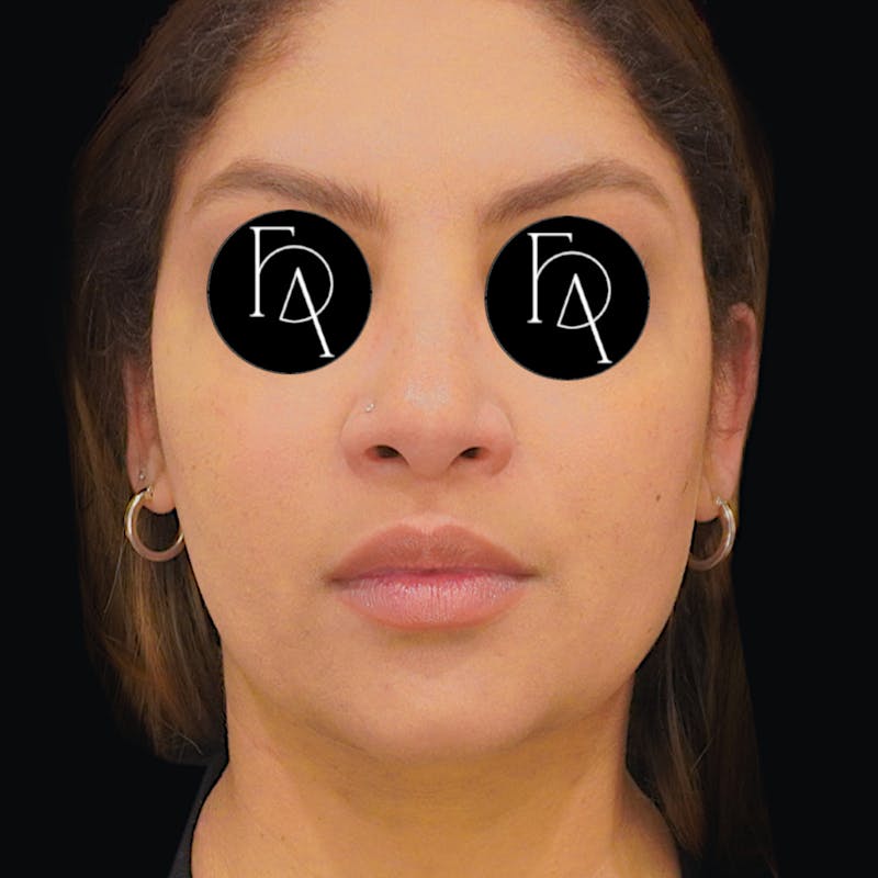 Submental Liposuction Before & After Gallery - Patient 162446 - Image 6
