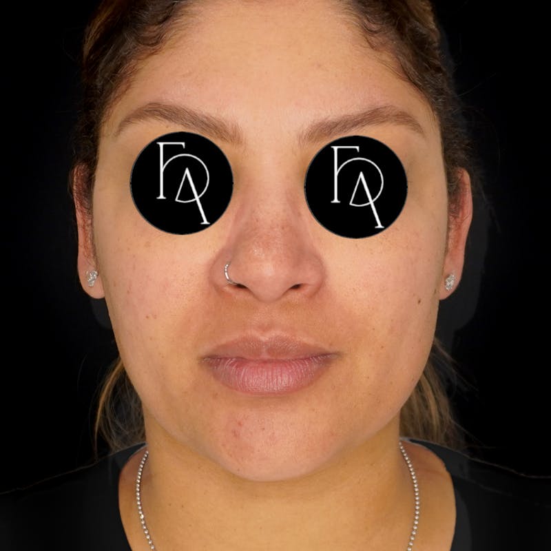 Submental Liposuction Before & After Gallery - Patient 162446 - Image 5