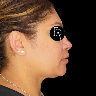 Submental Liposuction Before & After Gallery - Patient 162446 - Image 1