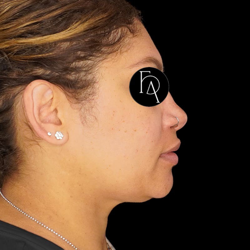 Submental Liposuction Before & After Gallery - Patient 162446 - Image 1