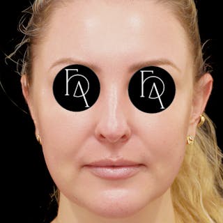 Buccal Fat Removal Before & After Gallery - Patient 132611 - Image 4