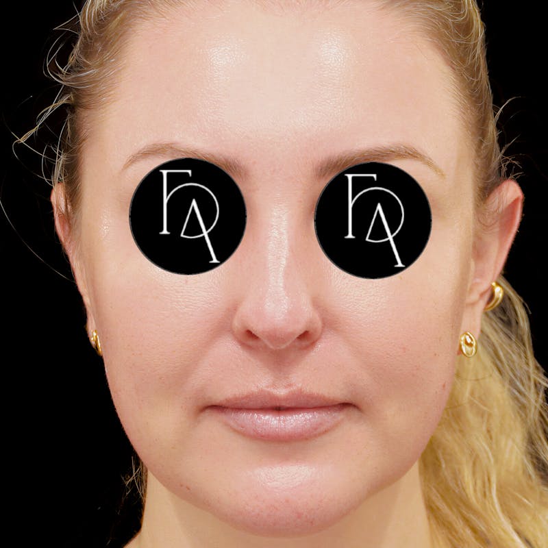 Buccal Fat Removal Before & After Gallery - Patient 132611 - Image 4