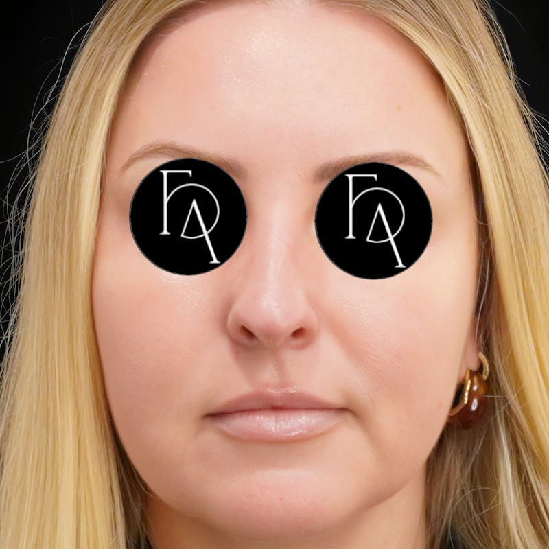 Buccal Fat Removal Before & After Gallery - Patient 132611 - Image 3