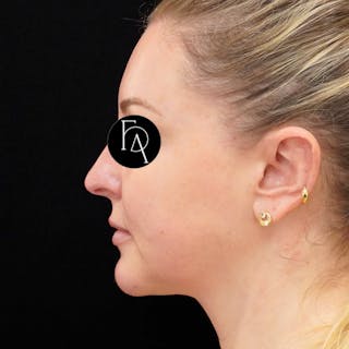 Buccal Fat Removal Before & After Gallery - Patient 132611 - Image 2