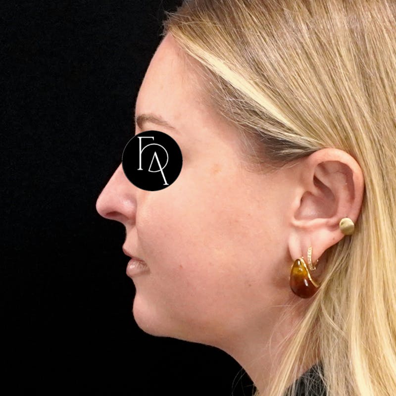 Buccal Fat Removal Before & After Gallery - Patient 132611 - Image 1