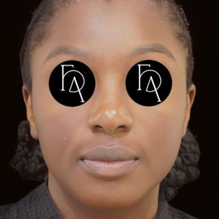 Buccal Fat Removal Before & After Gallery - Patient 333178 - Image 4