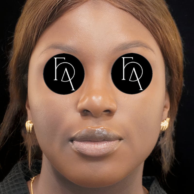 Buccal Fat Removal Before & After Gallery - Patient 333178 - Image 3