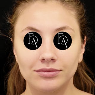 Buccal Fat Removal Before & After Gallery - Patient 254657 - Image 4