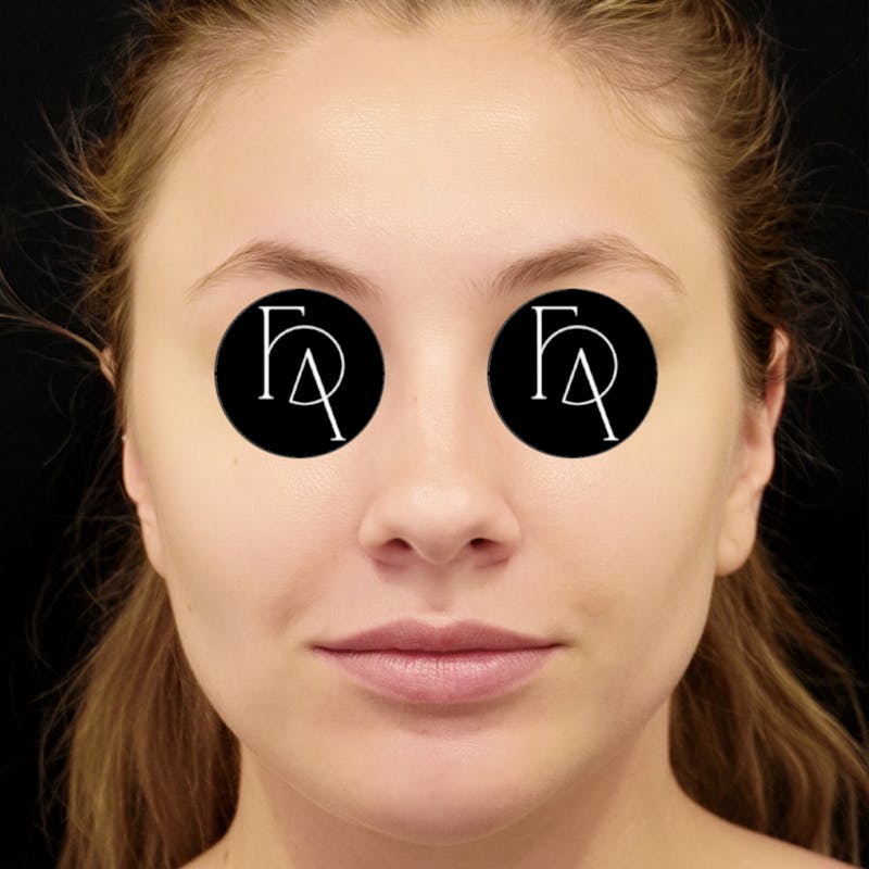 Buccal Fat Removal Before & After Gallery - Patient 254657 - Image 4