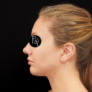 Buccal Fat Removal Before & After Gallery - Patient 254657 - Image 2