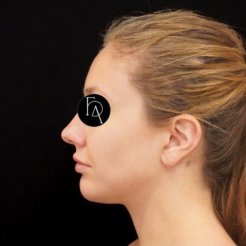 Buccal Fat Removal Before & After Gallery - Patient 254657 - Image 2