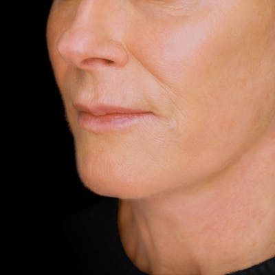 Deep Plane Facelift Before & After Gallery - Patient 302387 - Image 2