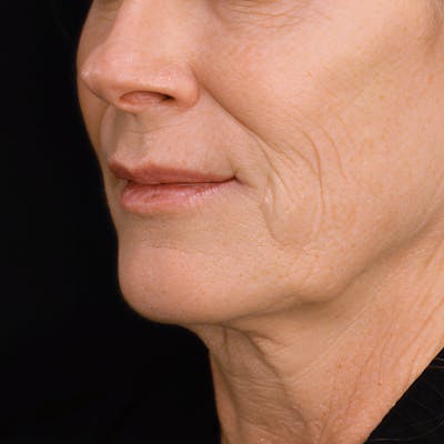 Deep Plane Facelift Before & After Gallery - Patient 302387 - Image 1