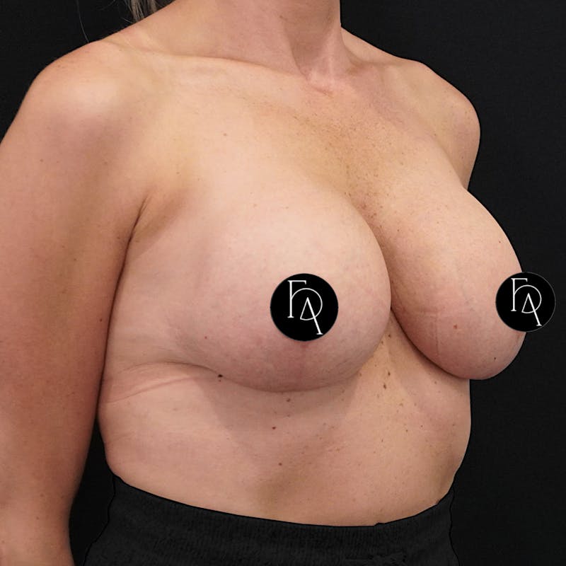 Breast Lift + Augmentation Before & After Gallery - Patient 172671 - Image 4