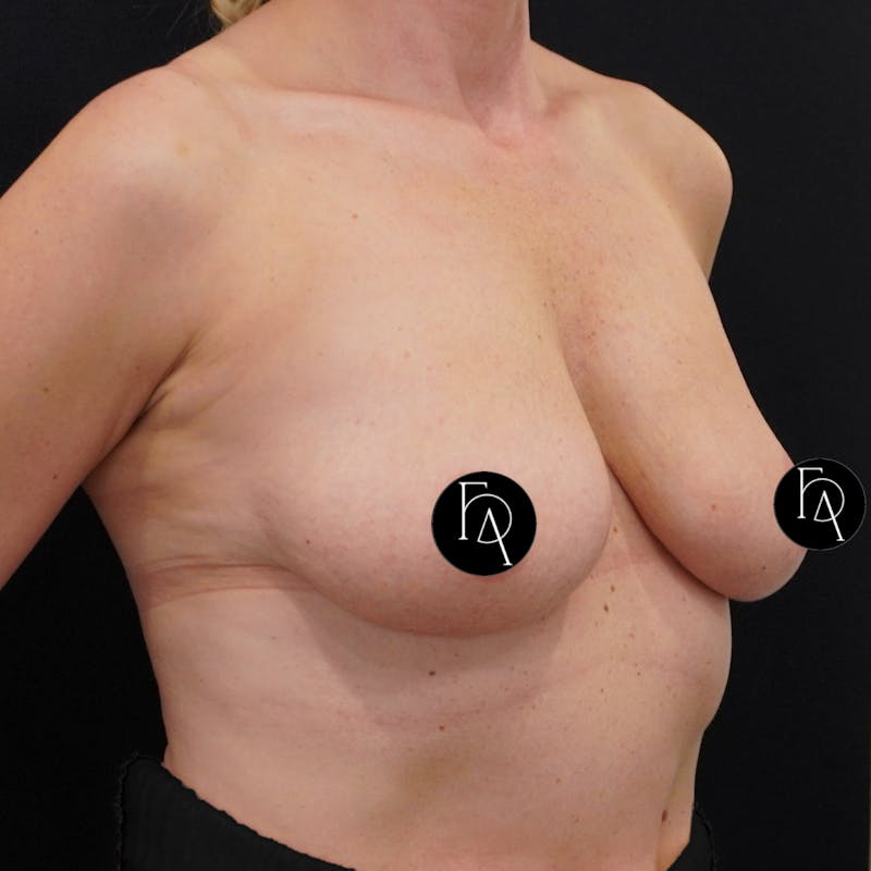 Breast Lift + Augmentation Before & After Gallery - Patient 172671 - Image 3