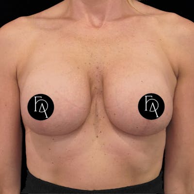 Breast Lift + Augmentation Before & After Gallery - Patient 172671 - Image 2