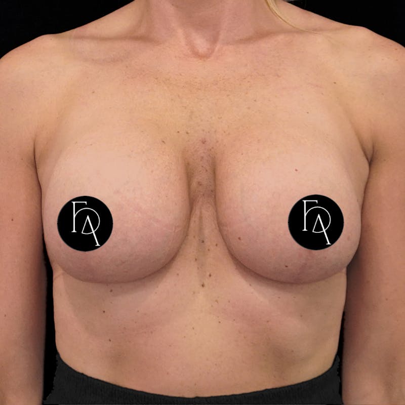 Breast Lift + Augmentation Before & After Gallery - Patient 172671 - Image 2