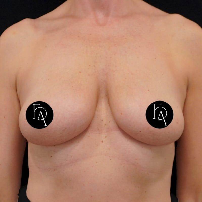 Breast Lift + Augmentation Before & After Gallery - Patient 172671 - Image 1
