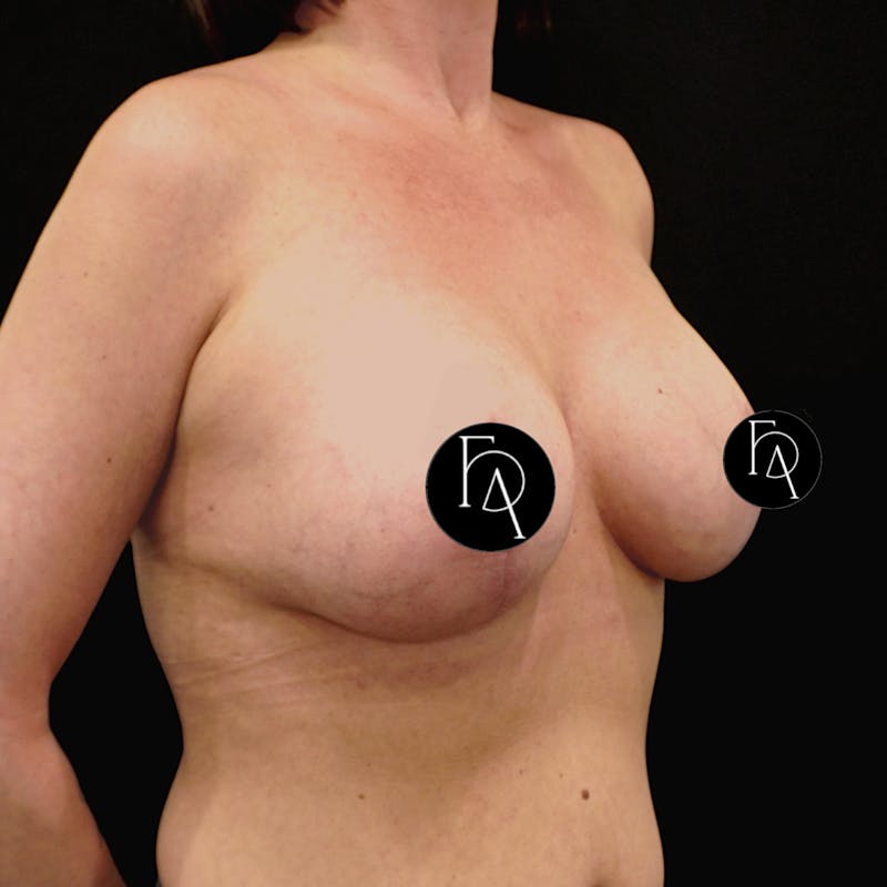 Breast Lift + Augmentation Before & After Gallery - Patient 152433 - Image 4
