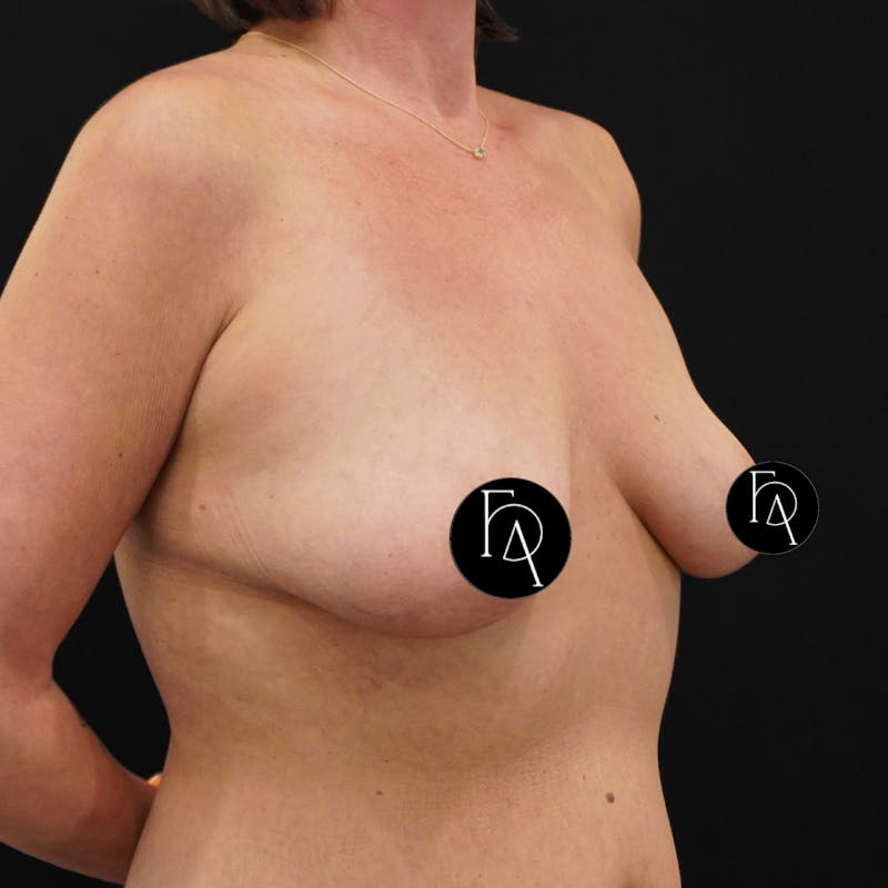 Breast Lift + Augmentation Before & After Gallery - Patient 152433 - Image 3