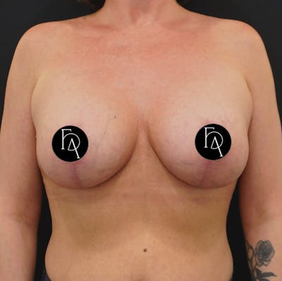 Breast Lift + Augmentation Before & After Gallery - Patient 152433 - Image 2