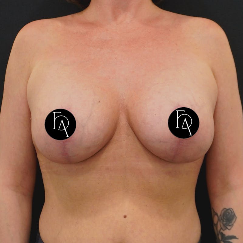 Breast Lift + Augmentation Before & After Gallery - Patient 152433 - Image 2