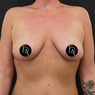 Breast Lift + Augmentation Before & After Gallery - Patient 152433 - Image 1