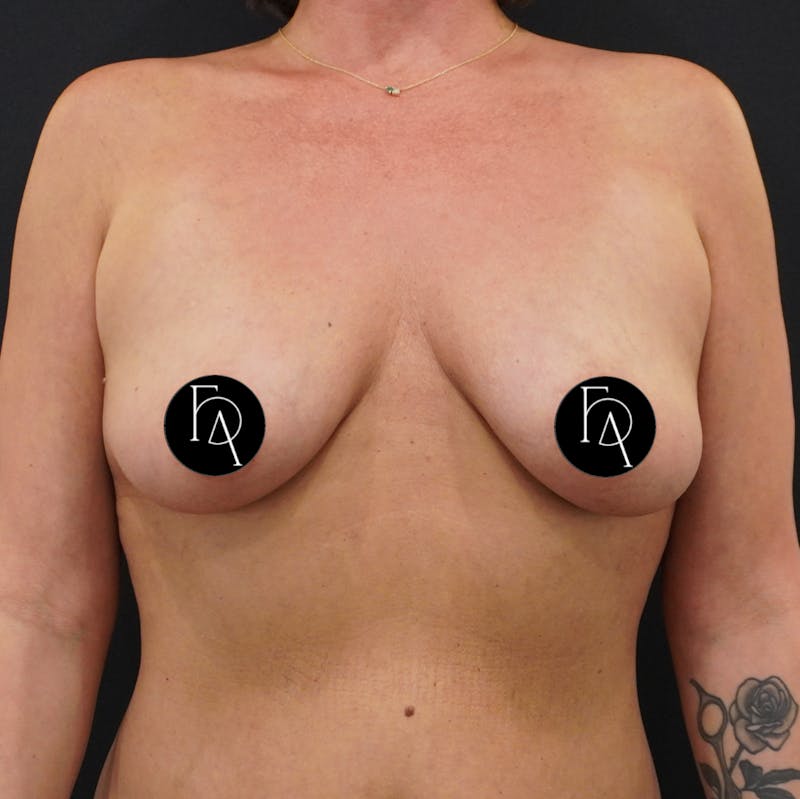 Breast Lift + Augmentation Before & After Gallery - Patient 152433 - Image 1
