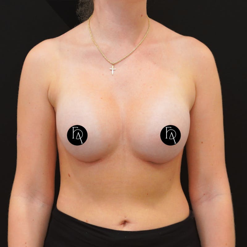 Breast Augmentation Before & After Gallery - Patient 175968 - Image 2