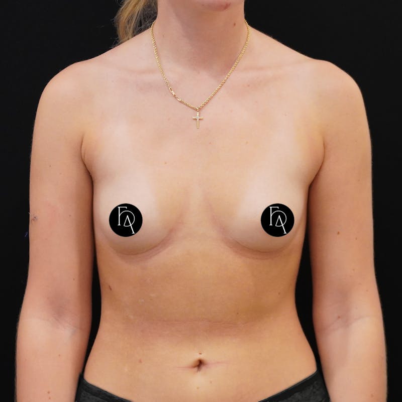 Breast Augmentation Before & After Gallery - Patient 175968 - Image 1