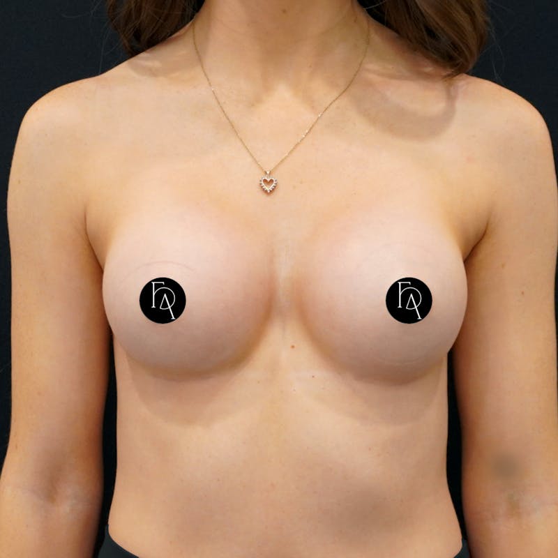 Breast Augmentation Before & After Gallery - Patient 224450 - Image 2