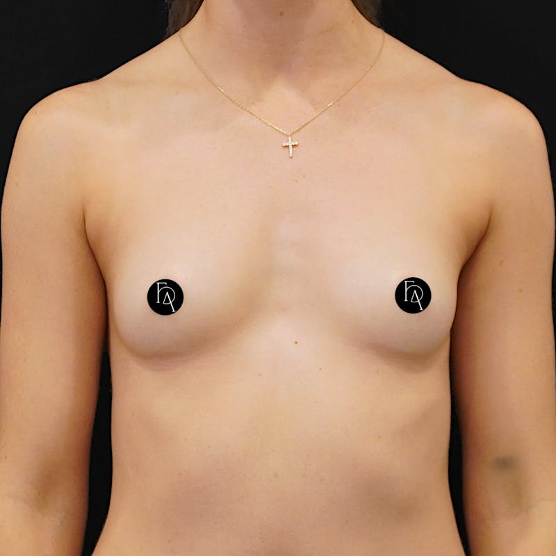 Breast Augmentation Before & After Gallery - Patient 224450 - Image 1